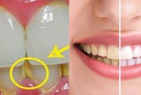 Cara Menghilangkan Karang Gigi Paling Efektif